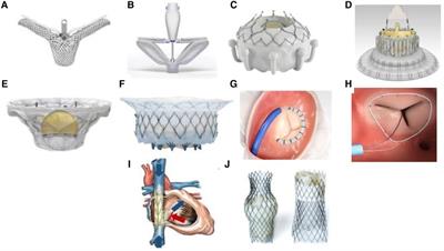 Multimodality imaging for transcatheter tricuspid valve repair and replacement